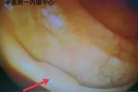 绝大多数没有任何症状！体检查出肠息肉，切除后就不用管了吗？图片