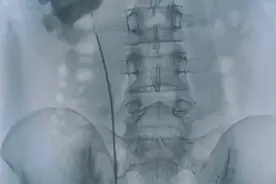 【朝医新闻】泌尿外科完成一例孤立肾输尿管狭窄修复术图片