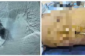 尿毒症患者没了透析通路无法“排毒”，医院为其再造“生命线”图片