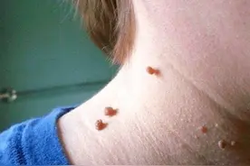 脖子上的小肉粒说明身体这里出了问题！一定要注意！图片