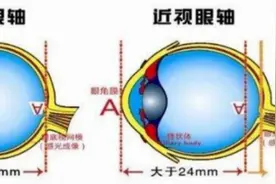 高度近视是“病”，不只是戴厚镜片那么简单图片