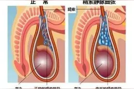 征兵体检淘汰率升高，背后是“精索静脉曲张”惹的祸图片