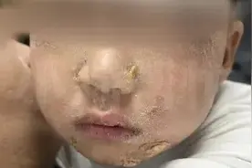 3岁娃吃火锅烫嘴后，全身溃烂！医生：会传染图片