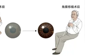 角膜移植术后护理不注意这些事项，可能引起大问题！图片