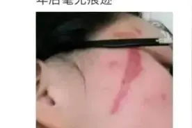 毒液堪比硫酸！这种虫子不要拍，近期多人受伤图片