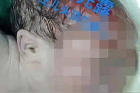 分娩时的“面先露”是怎么回事？菏泽市三院专家这样说图片