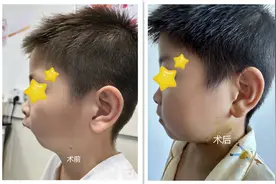 男童下巴缩短像“鸟嘴”，确诊小颌畸形综合征图片