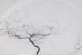 女子头晕后双目失明，竟是大脑血管“冒烟”图片