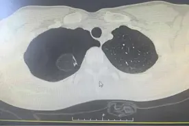 潍坊专家为您解答：如何应对青少年自发性气胸？图片