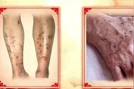 想想都可怕，腿脚有这五个信号，可能有糖尿病了！图片