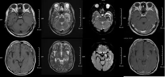 智力退化至3岁！年轻人患“脑膜炎”病例为何频发？