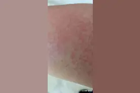 10款脱毛膏测评：有产品试用后出现皮肤红肿刺痛图片