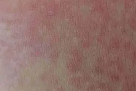 10款脱毛膏测评：有产品试用后出现皮肤红肿刺痛图片