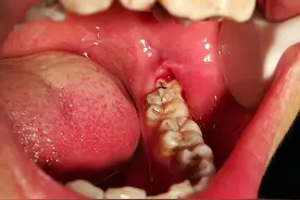 牙齿一吃冷热就酸痛无比，到底是怎么回事，需要拔掉吗？图片