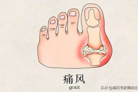 痛风发作要持续多久才好？还有这3个时期的区别，熬过去就好了图片
