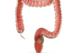 便血，排便异常，注意了！快做个肠镜检查一下。图片