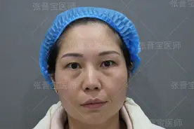 40岁大姐选择微创去眼袋，7天就完全恢复，和大家说说过程效果图片