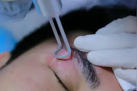 激光可以祛疤吗？效果怎么样？图片