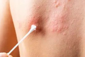 不要再走弯路了，过来人经验，帮你告别7个靶向药副作用！图片