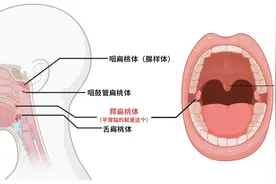 口腔内长出“玉米粒”，捏扁了还臭臭的，这到底是啥？图片
