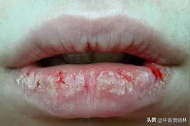 嘴唇干裂疼痛？3个中成药，健脾、滋阴、祛湿，拔除病根图片