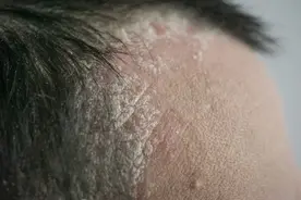 腿上皮屑就像下雪？是得了皮肤病？医生，有3种可能图片
