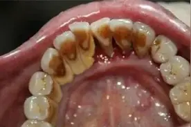 疯长的牙结石又黄又臭！闲时在家试试它，再顽固的牙石都能掉!图片