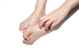 脚底有跖疣，走路都痛，专家告诉你该如何治疗图片