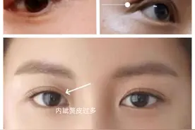 双眼皮手术后分叉明显，原因在哪？想改善只能这样了！图片