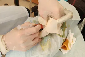 济南市莱芜人民医院 ：可视化针刀巧治“弹响指”图片