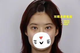 双眼皮术后为什么显老？可能是和这4个因素有关，大家需谨慎选择图片
