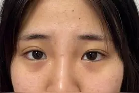 26岁女生大小眼、单双眼皮、术后效果公开！图片