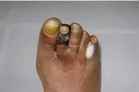 小腿疼，腿肚子酸胀要警惕了图片