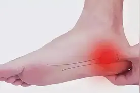 脚踩地板时足跟锥心痛？你可能是跟痛症图片