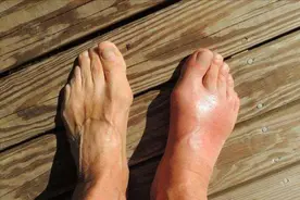 痛风通常从脚部开始发作！日常坚持做好这4件事，有效抑制疼痛！图片