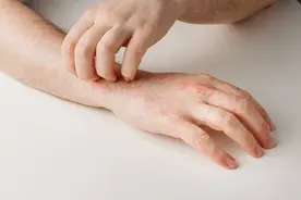 身上的“小红点”不痛也不痒，是咋回事？与哪些因素有关？图片