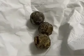 胆囊结石被我切开了图片