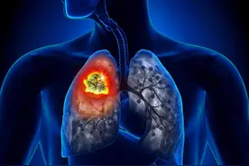 肺癌有什么症状?图片