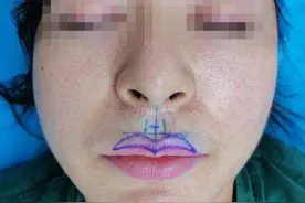 小姐姐对人中和M唇的缩短提出了挑战，手术很可怕，但结果却很惊图片