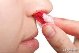 鼻腔出血后，头向后仰？塞入纸巾？这些止血做法其实都是错误的图片