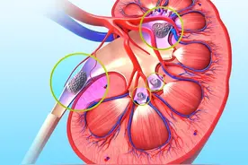 27岁小伙汗蒸减肥，引发肾功能衰竭，医生提醒：这些错误别再犯图片