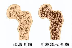艾滋病病人如何拥有健康的骨骼？一文读懂终生受用图片