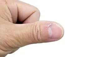 大拇指边一按就疼，是什么在“作祟”？4个妙招，轻松预防甲沟炎图片