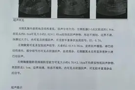 长治市第二人民医院：一例“隐匿性”乳腺癌改良根治术图片