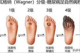 百姓健康 | 不容忽视的糖尿病足病图片