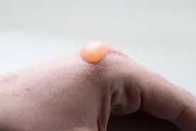烫出水泡后，怎么能尽快恢复？看看医生怎么解答，你会了吗？图片