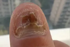 指甲发黄增厚还掉渣？保姆级教学教你在家就能轻松祛灰！！图片