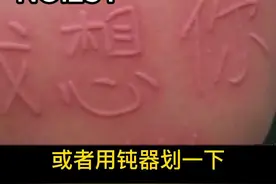 #创作灵感 皮肤一抓一条条红色凸起，能“写”字，原来是#荨麻疹 怎么办？#人工荨麻疹 #皮肤划痕症视频封面
