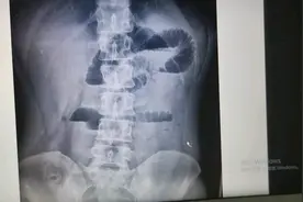 肠梗阻平片诊断一