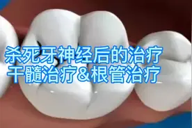 蛀牙打洞放药后的治疗有哪几种方法？分别是怎么样的？如何选呢？视频封面